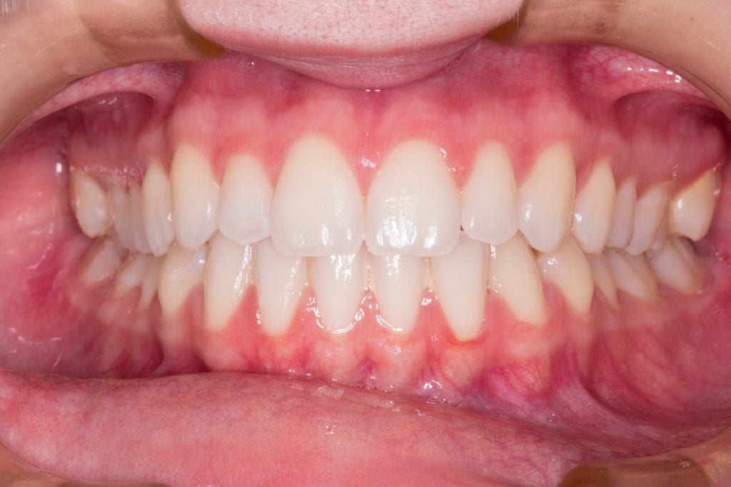 Das Problem mit dem Zahnfleisch